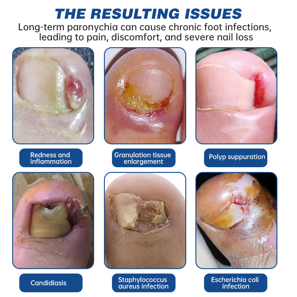 Seurico™ Herbal Formula Fungal nail Paronychia treatment Gel