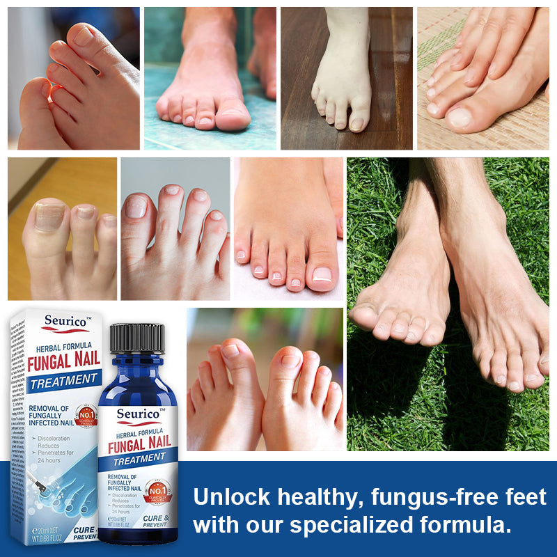 Seurico™ Herbal Formula Fungal nail Paronychia treatment Gel